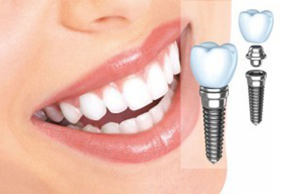 Diş sorunu olanlar dikkat, sahte implant taktırmayın