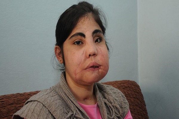 Türkiye'de yüz nakli yapılan ilk kadındı, hayatını kaybetti